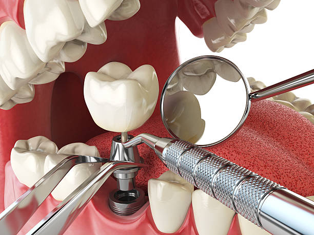Best Emergency Denture Repair in Bayshe, OR
